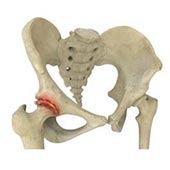 Inflammatory Arthritis of the Hip