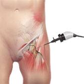 Hip Arthroscopy