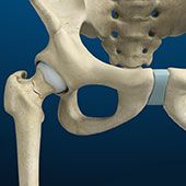 Hip Fracture Surgery