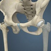 Hip Fracture