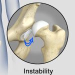 Hip Instability