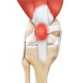 Kneecap Bursitis