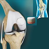 Osteochondral Injuries