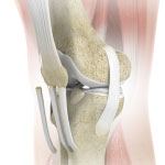 Patellar Tendon Repair