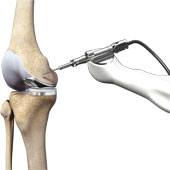 Robotic Assisted Knee Replacement